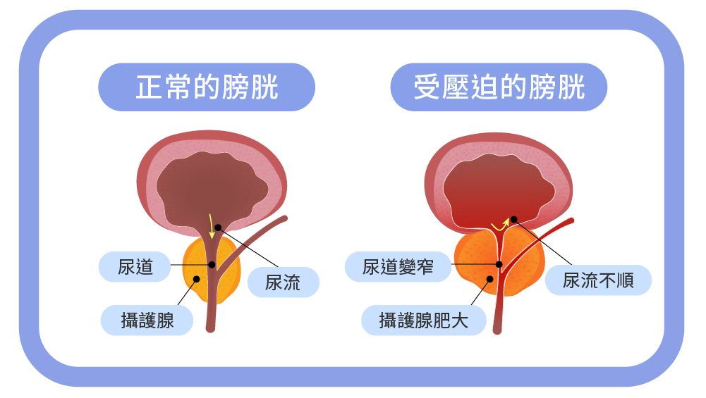 Dec.2024-楊昀達醫-師尿頻尿急夜尿多是攝護腺肥大引起的嗎？-02