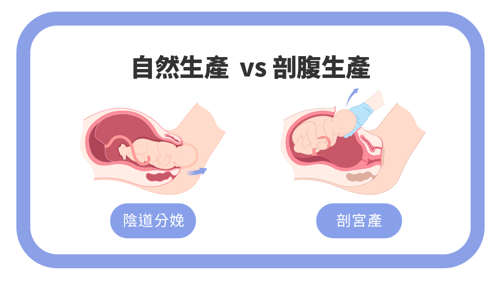 自然生產VS剖腹生產